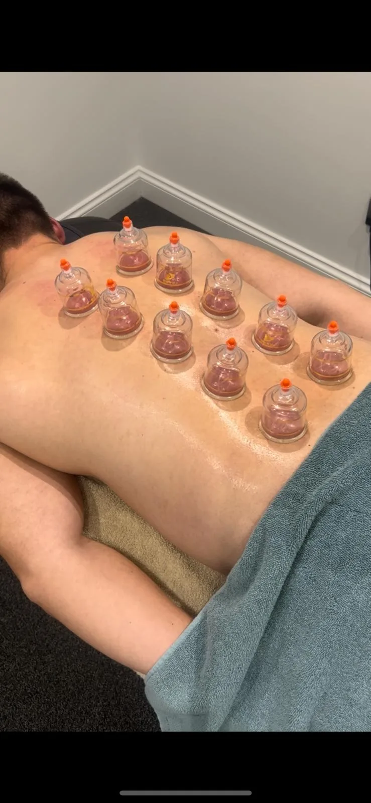 Myofascial cupping applied along a client's back during a treatment